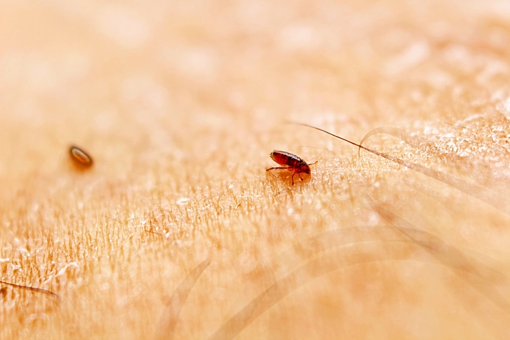 What Diseases Can Be Caused by Lice Infestation LiceDoctors